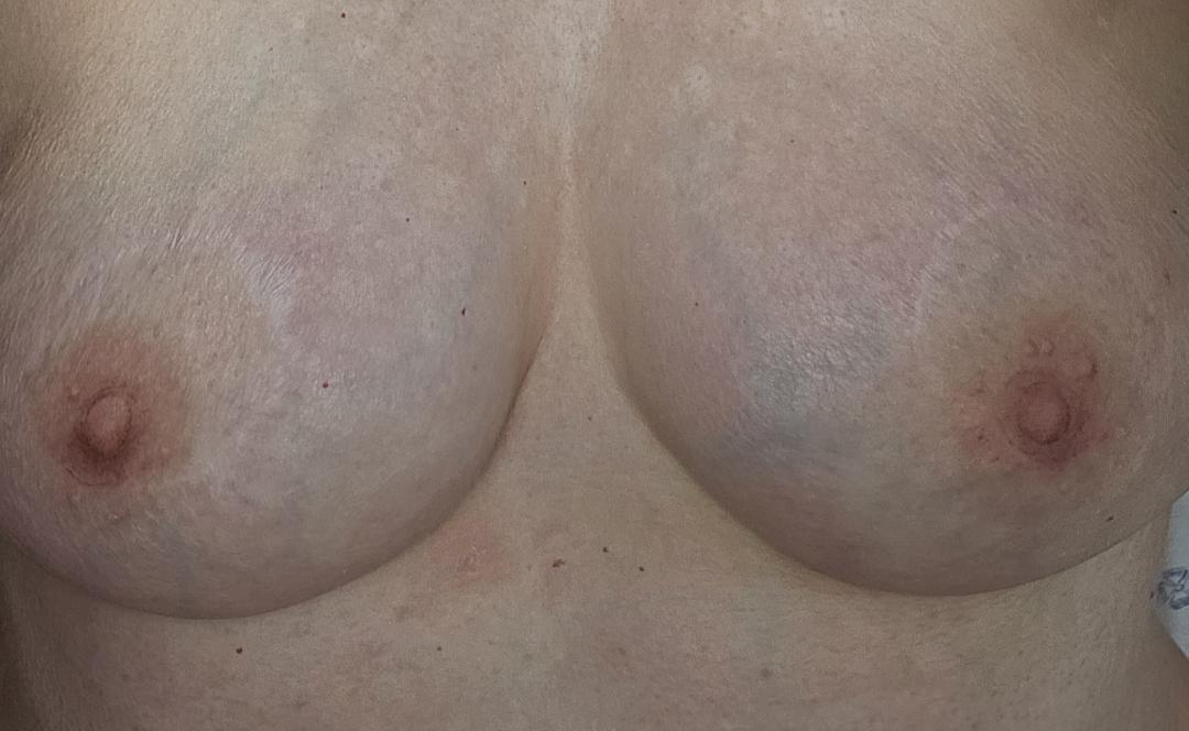 Fully healed bilateral natural areola restoration result